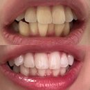 장유뉴욕치과병원 | 내돈내산 치아미백 하루만에 3회 솔직 후기 가격 서울 강남 신사역 레브 치과