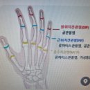 靑松 건강칼럼 (932)... 손가락골절 이미지