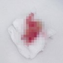 참이화약국 | 사랑이아프니치과의원 홍대점_첫째 사랑니 발치후기