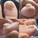 누벨르프리미엄라운지 | 구미내성발톱 발톱무좀 문제성발관리, 발톱비대증관리도 인동네일샵 누벨르라운지에서!