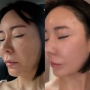 히트 | 피부과 피부 리프팅 레이저 써마지 flx 관리 티타늄 가격 붓기 효과 히트업 써마지 후기