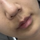 김해바를정치과의원 | 팔자에만 600만원 박은 사람의 팔자주름필러 극솔직후기 내돈내산(추천?비추천?)