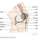 슬개골연골연화증; 膝蓋骨軟骨軟化症 Runner's Knee 이미지