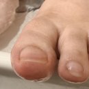 빈야드네일 | 청주내성발톱교정 미라쓰네일에서 관리받고 샌들 신게 된 후기