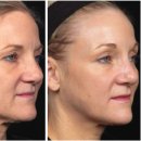 하나로부분정비 | 울쎄라써마지가격부터 효과까지, 이 글 하나로 종결합니다&lt;필독&gt;