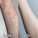 풀독 | 풀독 두드러기 증상 연고 치료 응급 처치법까지 숙지하세요