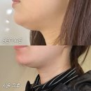 온다헤어(ONDA HAIR) | 이중턱 탈출 온다리프팅 홍대피부과 직접 받아본 한달 후기