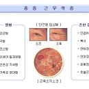 근무력증 치료 이미지