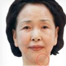 바노바기성형외과의원 네이버블로그