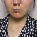 부산 서면 피부과 온다 리프팅 5만줄 솔직후기