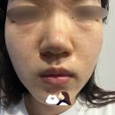 무통 리투오 스킨부스터와 쥬베룩 든 비교후기_통증,부작용,가격