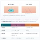 41190-01-07-211 | 6편 - 쥬베룩 VS 필러— 꺼진 얼굴엔 무엇을 해야 할까?/은평구 아크메의원 칼럼