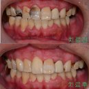동그라미치과의원 | 동두천치과 심한충치 신경치료 및 크라운치료 후기