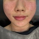 보름달전집 | 강남 여드름압출 잘하는 곳, 보름달뷰티 논현본점 여드름피부 후기