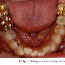 치아가 상실된지 오래된 치아 ▶ 임플란트치료 이미지