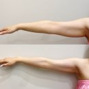 바른에스테틱 | ✨청라 팔뚝살 실화?! 단 1회 관리로 드레스라인 살아난 “바른에스테틱” 리얼후기✨