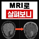 기억과 치매 | 치매초기증상 예방에 좋은 영양제, MRI 전후사진으로 살펴본 실제후기