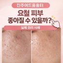 수피부관리 | [공지] 진주여드름흉터 요철 피부 좋아질 수 있을까? 평거동피부관리 실제 후기