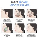 안면거상수술 진행과정과 필수 체크항목