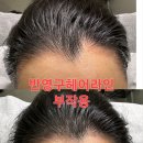망했던 헤어라인 복구한 후기 - 강남반영구아카데미 투엠메이크업