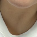 엄지한의원 | 홍제온한의원 | 점, 비립종, 사마귀 무제한 제거 다녀온 솔직후기 (내돈내산)