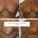 여유증이 재발하는 경우도 있나요?? 이미지