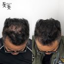 잉크천지(본점) | 인천 두피문신 왜 경험 많은 시술자를 찾아야 할까요?