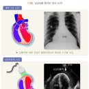 심낭 삼출 증상 이미지
