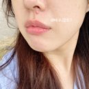 보습미백 밀크필 후기, 목동 여드름/피부진료 한의원