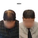 모멘즈 | 마곡smp 모멘즈 역대급 탈모커버 후기
