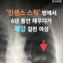 '인센스 스틱' 방에서 6년 동안 태우다가 폐암갈린 여성 이미지