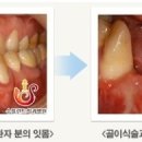 수플란트 이미지