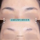 영수목욕탕 | 창원눈썹문신제거 3회차 찐찐후기!! (붉은색 잔흔있음+통증, 비용)