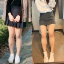 바이오카리스 | [신촌] 허벅지 지방추출주사 2개월 반 후기 총정리(QnA/ 비용 / 가격)