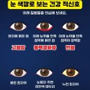 ■ 눈 색깔로 보는 건강 적신호 이미지