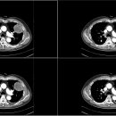 Pulmonary carcinosarcoma(rare case) 이미지