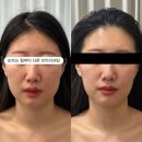 마음;쉼에스테틱 | W14. 대전 신부관리 마음쉼에스테틱 내돈내산 찐추천 후기(얼굴 리프팅 5회, 상체 슬리밍 5회)-2