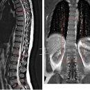 호이리 님의 척추부위 전체 MRI 사진입니다. 이미지