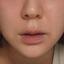 화목약국 | 모낭염으로 2000만원 넘게 써보고 현재상태