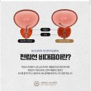 서울리더스비뇨의학과의원 | 전립선비대증 수술 비용 효율적으로 선택하려면