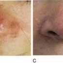 침치료의 피부미세순환 개선을 통한 주사비(Rosacea)의 치료 이미지