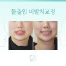 영주스마트치과의원 | 돌출입 비발치교정 치아교정으로 교정비용 아끼는 방법