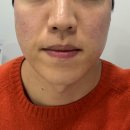 미세상피부과의원 | 화성 향남 피부과 맥스웨이브 미쥬란 시술 후기 효과 통증