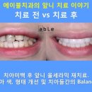 에이블치과기공소 네이버블로그