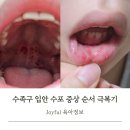 (주)피알디 | 수족구 입안 수포 증상 순서 격리기간 경험담