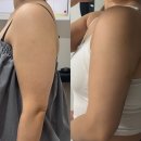 청담다이어트병원 지방분해주사 팔뚝 제로팻 후기 1탄