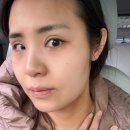 비너스달걀주사 , 사각턱, 옆광대 볼꺼짐 개선 후기