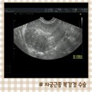 양이멍이 | 내막에 가까운 자궁근종 생리과다 복강경 수술 통증 후기