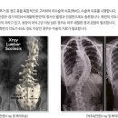 척추측만증 (scoliosis) 이미지