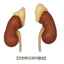 선천성 부신과다 형성증[Congenital adrenal hyperplasia]유전질환 이미지